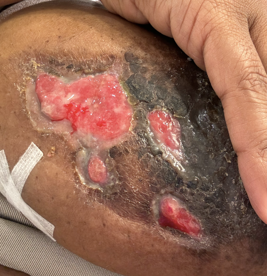 Skin starting to heal a bit after drainage.